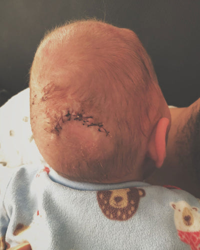 Jaxon's 4th Emergency Shunt Surgery